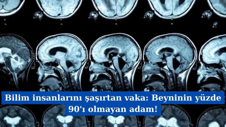 Bilim insanlarını şaşırtan vaka: Beyninin yüzde 90’ı olmayan adam!